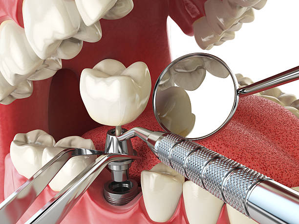 Best Holiday Emergency Dentist in Ivanhoe, CA